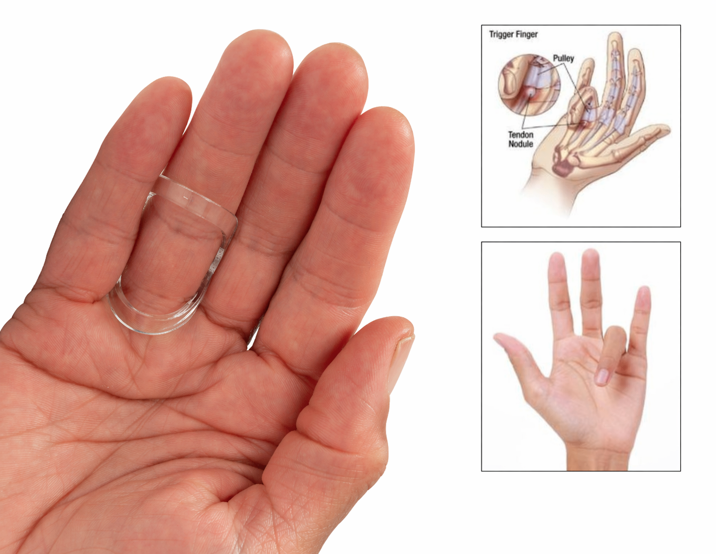 Using a Finger Splint For the Treatment of Trigger Finger