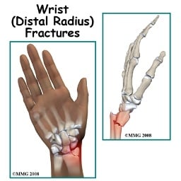 Distal Radius Wrist Fractures: Tips for Rehabilitation