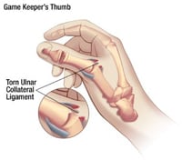 How to treat Gamekeeper's or Skier's Thumb - 3-Point Products